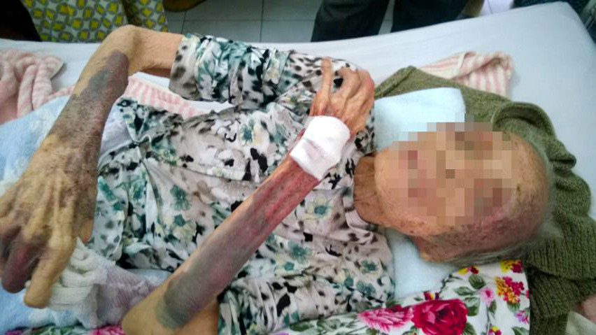 Bà Bảy vết thương thâm tím người vì con ruột đánh. Ảnh: Thanh niên