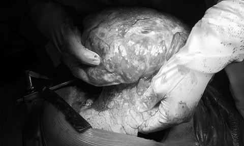 Mang khối u “khủng” trong phổi, đẩy lệch tim sang ngực phải