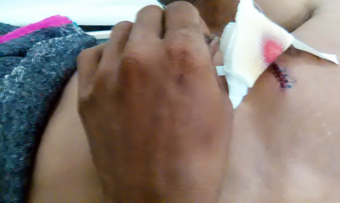 Vết thương trên ngực của ông K'Dem