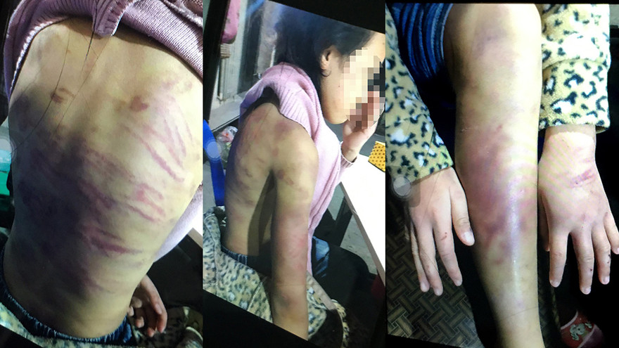 Những vết thương thâm tím, rỉ máu trên người cô bé 12 tuổi được cho bị chính mẹ ruột đánh đập