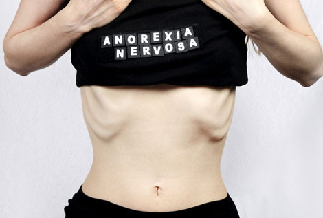 Luật mới về chỉ số BMI của Israel nhằm chống lại chứng rối loạn chán ăn.