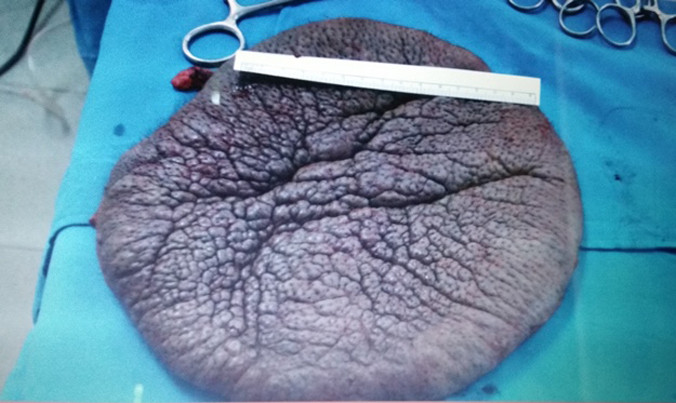 Khối bướu sau khi được lấy ra khỏi lưng “cô bé mai rùa” với đường kính hơn 22cm, nặng hơn 1kg. Ảnh do bệnh viện cung cấp.