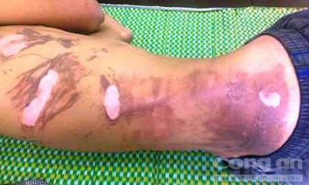 Nam thanh niên bị bỏng nặng. Ảnh: bệnh viện cung cấp.