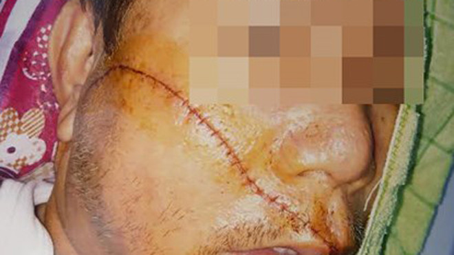 Vết chém từ trên tai xuống dưới cằm nạn nhân