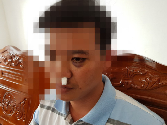 Thầy Bảo bị đánh gãy xương mũi