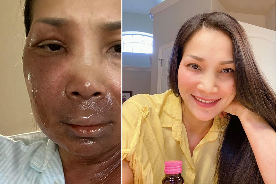 Hồng Ngọc đúc kết điều quý giá sau tai nạn bỏng nặng mặt và ngực