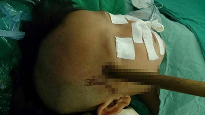 Con dao dính chặt vào đầu bệnh nhi.