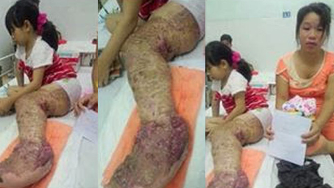 Chân Loan lở loét 10 năm nay.