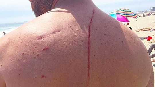 Anh Eugene Finney bị thương ở lưng. Ảnh: CBS Boston.