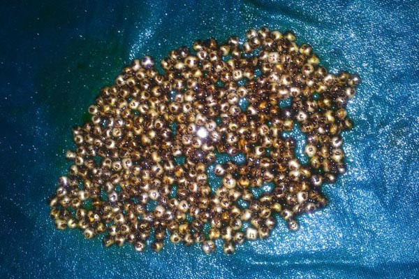 Những viên sỏi nhỏ trong túi mật bà Mousumi Dam. Ảnh: Cover Asia Press.