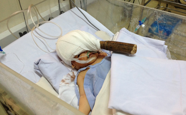 Bé sơ sinh 11 ngày tuổi nhập viện với lưỡi dao cắm sâu trong đầu. Ảnh do bệnh viện cung cấp.