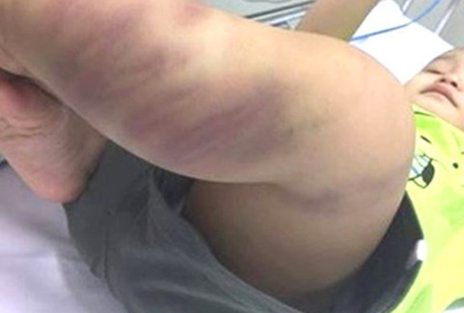 Bé trai 1 tuổi nhập viện trong tình trạng hôn mê, co giật, mắt bị giãn, bầm tím toàn thân và xây xước ở bộ phận sinh dục, cổ.