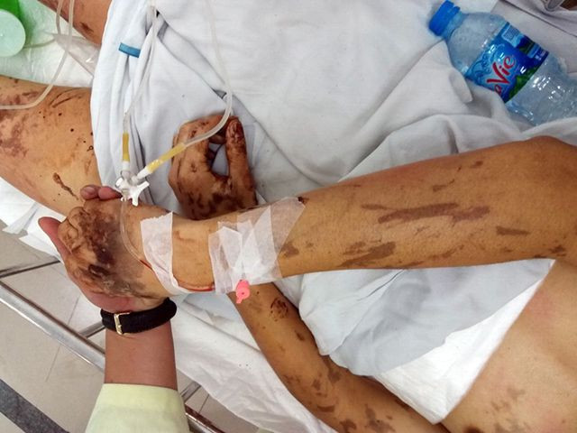 Võ Duy Nghiêm bị tạt axit, cắt gân chân khi về quê ăn tết