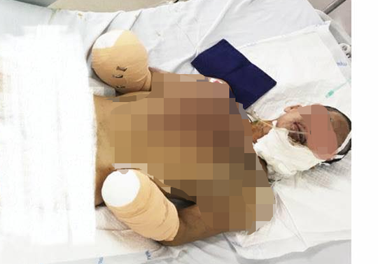 Hiện sức khoẻ bệnh nhân đã ổn định, tuy nhiên vụ pháo nổ đã để lại di chứng nặng nề