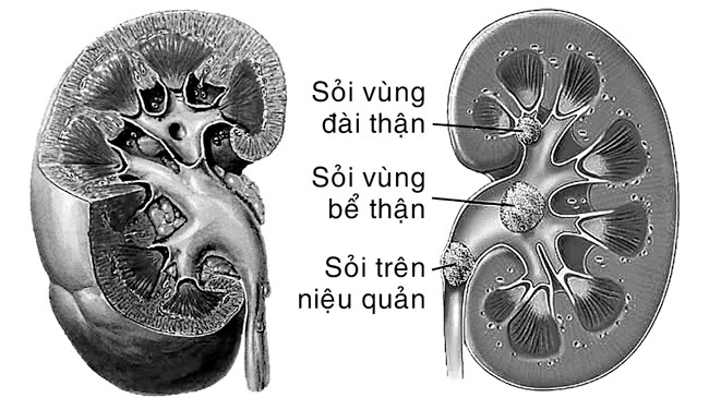 Sỏi thận - Ngăn ngừa tái phát trong điều trị