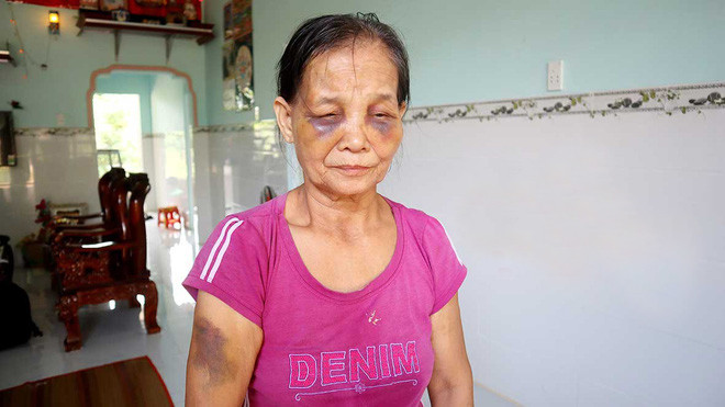 Khuôn mặt bầm tím của bà Tạo. Ảnh: Báo Bình Phước