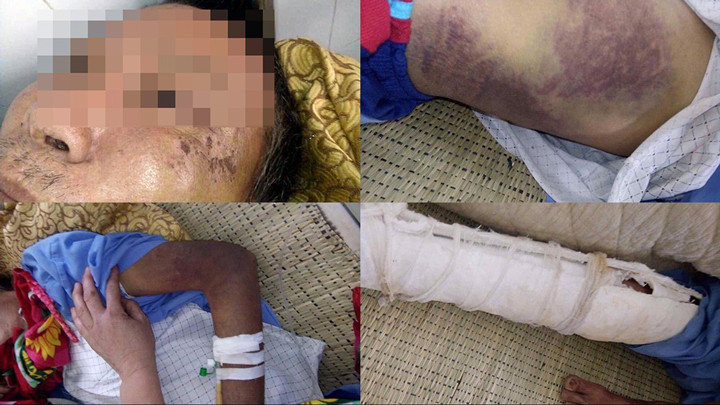 Ông N. và những vết thương chưa lành đang được điều trị tại bệnh viện.