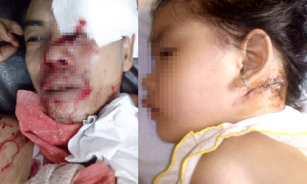 Ông Thiệt với vết thương ở vùng mặt và bé Nguyễn Ngọc Thảo Vy với vết thương sau gáy