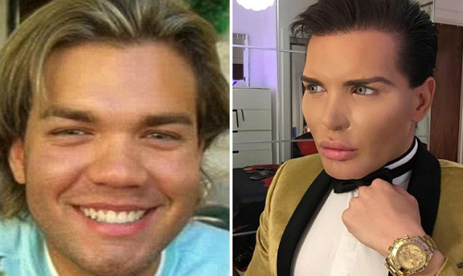 Rodrigo trước và sau khi phẫu thuật. Ảnh: DM & Rodrigo Alves.