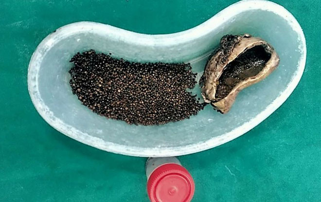 Ảnh: Hơn 4.000 viên sỏi được gắp ra từ túi mật của bệnh nhân. 