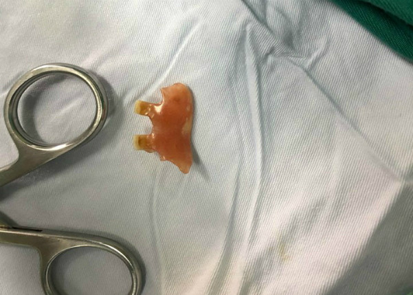 Một phần của hàm răng giả được lấy ra khỏi thanh quản bệnh nhân. Ảnh: Bệnh viện cung cấp. 