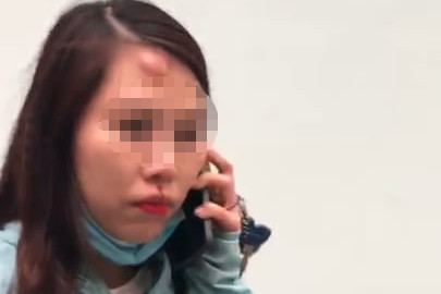 Chị A. bị đánh sưng mặt, chảy máu mũi.