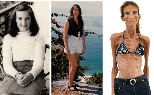 Valeria từ lúc là cô bé, thiếu nữ 19 tuổi và khi gầy trơ xương vì biếng ăn. Ảnh: B.M.