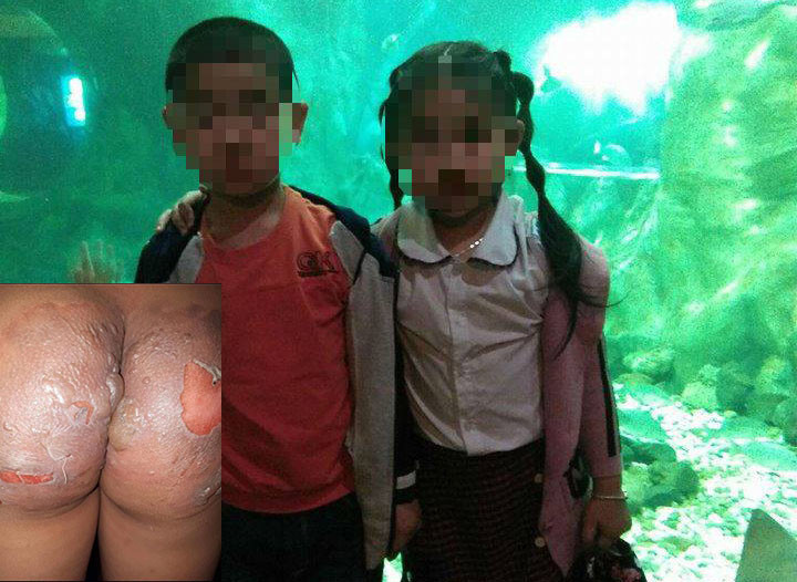 Hai cháu bé bị bỏng do bị hắt nước sôi vào người.