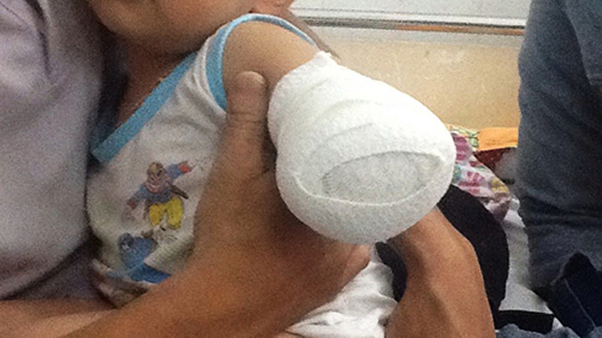 Cánh tay của bé sau tai nạn. Ảnh: Thiên Chương.
