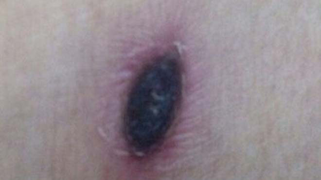 Vết đốt do côn trùng gây nên. Ảnh H.Hải