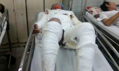 Nạn nhân bị bỏng nặng - Ảnh: Lê Huân