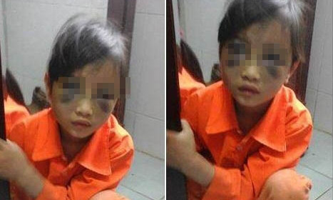 Em P.C.Th. bị thương thâm tím vùng mặt - Ảnh: Facebook