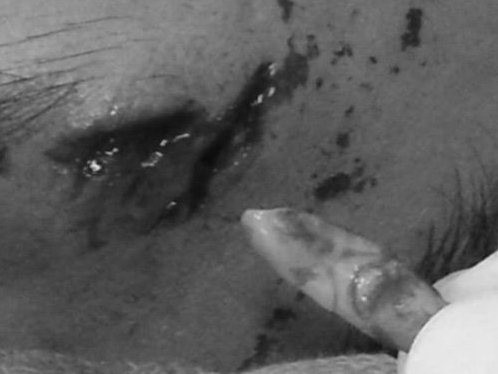 Chiếc răng được gắp ra từ trán chàng trai. Ảnh: Bác sĩ cung cấp.