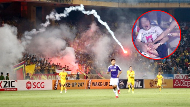 Nạn nhân H.A. bị vết rách lớn ở chân, máu chảy đầm đìa sau khi bị trúng pháo sáng