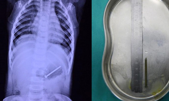 Chiếc đinh bị bé trai nuốt.