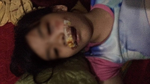 Bé gái N.T.A.T. bị chó "điên" tấn công, phải khâu 13 mũi.