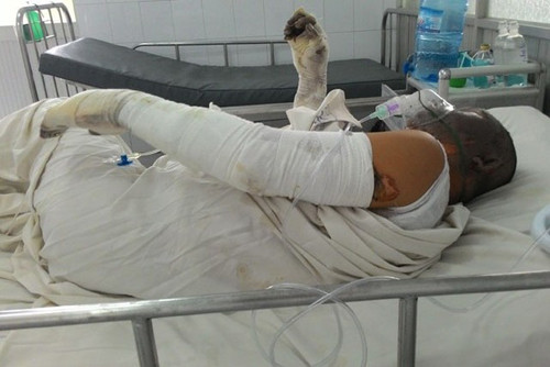 Anh T điều trị tại bệnh viện.