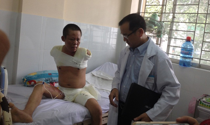 Bệnh nhân bị bỏng điện phải đoạn chi. Ảnh do bệnh viện cung cấp.