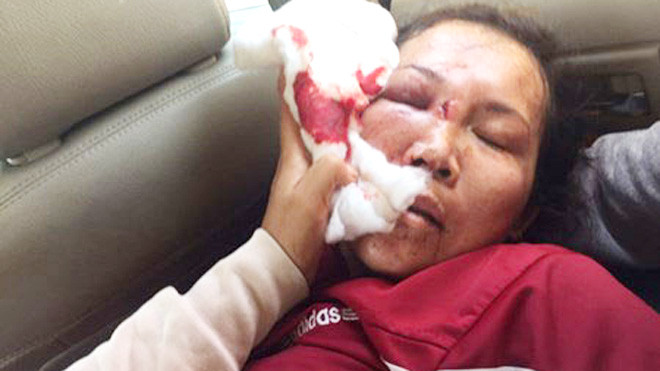 Nạn nhân Lê Thị Trường An bị gia đánh hội đồng do thiếu nợ tiền ghi đề cách đây 6 năm