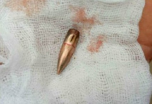 Đầu đạn lạc găm vào người dân ở thị trấn Gia Khánh