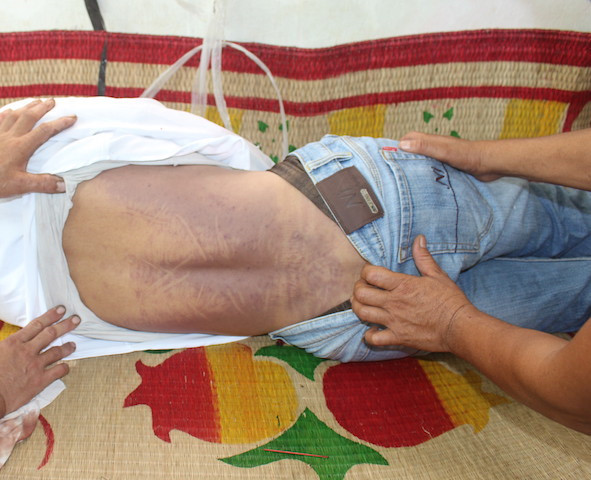 Vết bầm trên người anh Nhân