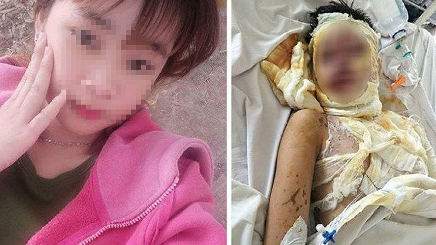 Chị Đ trước và sau bị tạt acid