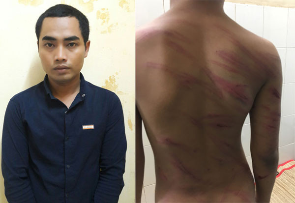 Vết thương trên người cháu P và đối tượngThạch Chane Sô Khum