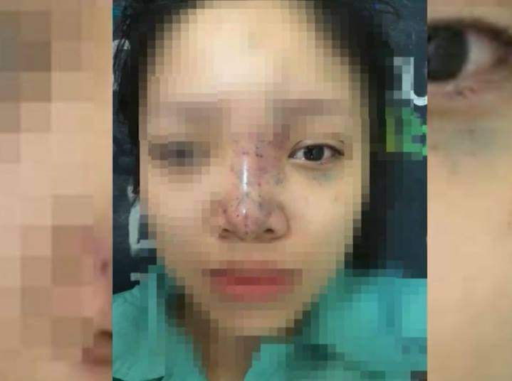 Bản tin 14H: Chủ spa tiêm filler cho sinh viên suýt mù mắt bỏ trốn