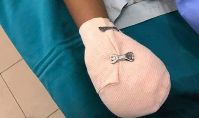 Bản tin 8H: Pin điện thoại phát nổ khi sạc, bé trai bị dập nát bàn tay