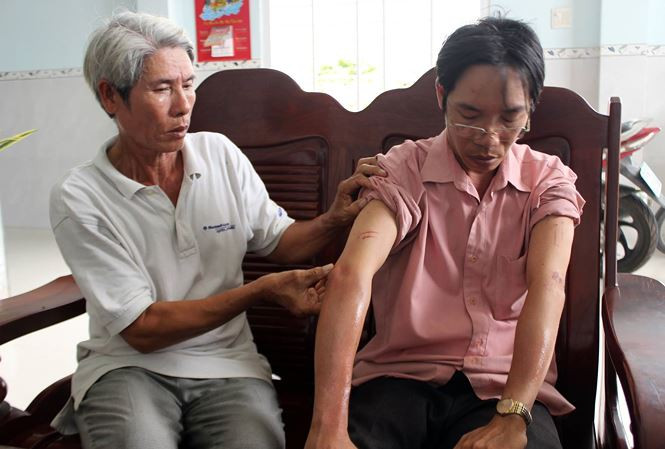  Anh Truyền với vết tích của roi điện tấn công.