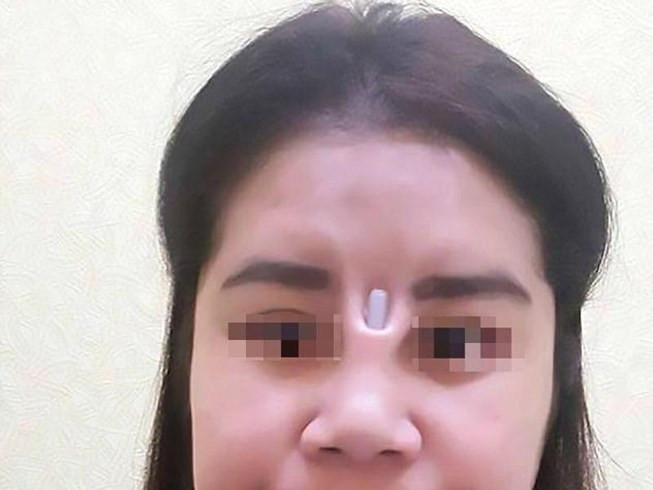 Bị thanh silicone đâm thủng mũi chòi ra giữa mặt