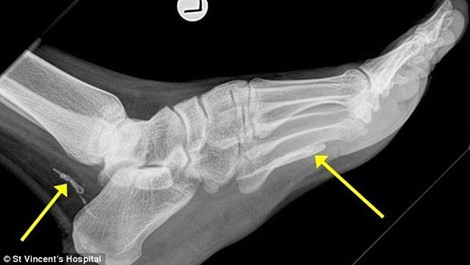 Ảnh chụp X quang cho thấy những phần còn lại của con giun