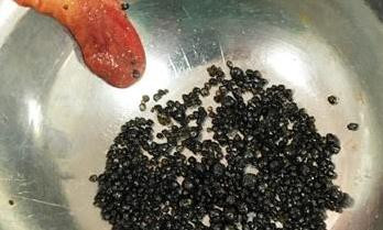 Gần 1.000 viên sỏi nằm trong túi mật nữ bệnh nhân