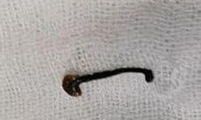 Con vắt được bác sỹ gắp ra từ mũi em Đoàn.